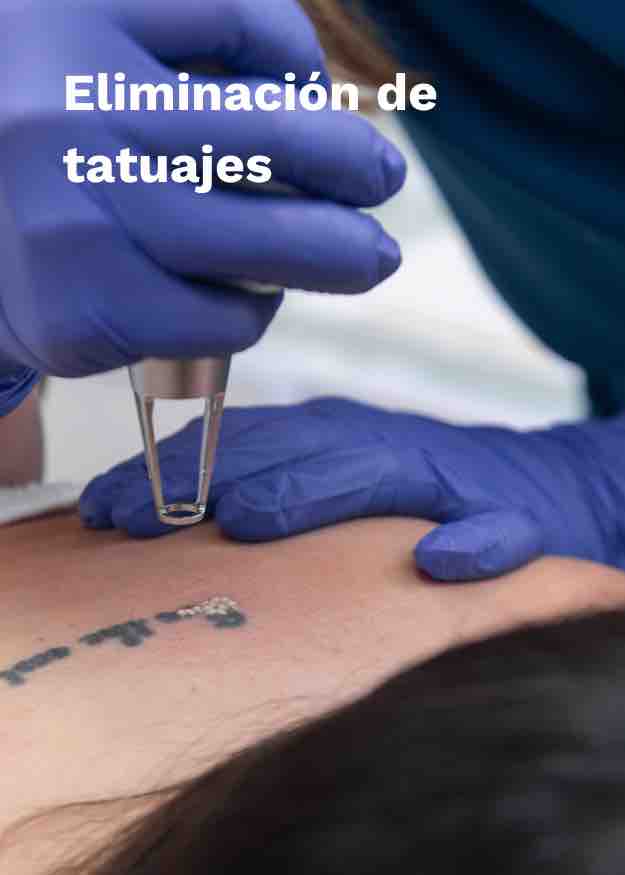 Imagen Eliminación de Tatuajes Corporal