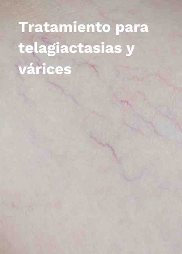 Imagen Tratamiento para Telangiectasias y Várices