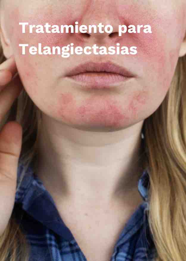 Imagen Tratamiento de Telangiectasias